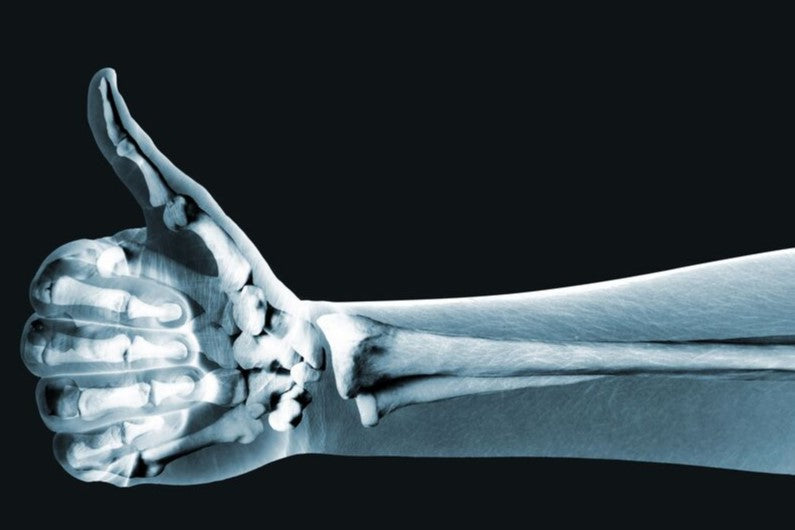 How to Improve Bone Health After Breast Cancer